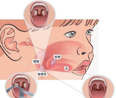 咽门缩桃丸治儿童扁桃体肿大