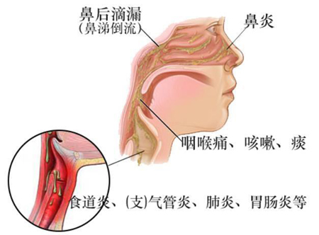 治鼻后滴漏综合征经验