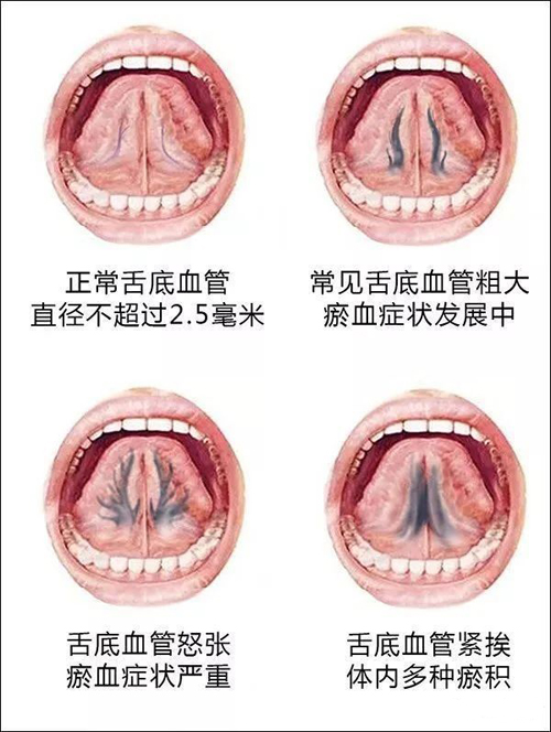 怎样舌下取栓？