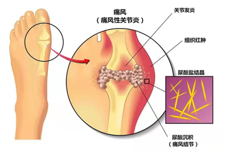 急性痛风关节炎的施灸方法