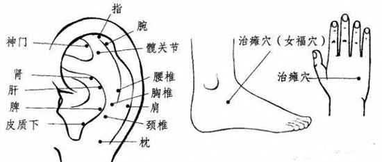 中风偏瘫，“治瘫点”是最方便的疗法