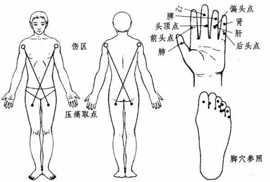 中风偏瘫，“治瘫点”是最方便的疗法