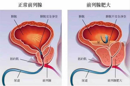 治前列腺肥大医案两则