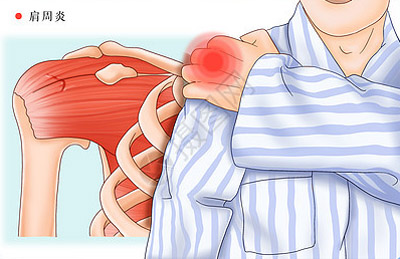 运用指针疗法治疗肩周炎经验分享