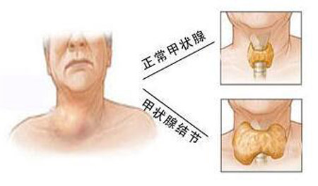 中医治甲亢、甲减思路