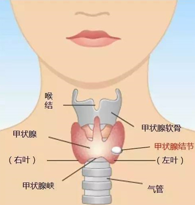 消瘿五海丸治瘿瘤、瘰疬、乳核胀痛……