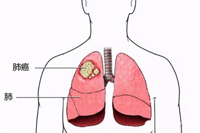 中医论治思路：肺癌的发生发展与命门火衰有极大关系！